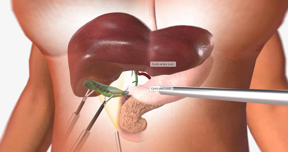 حصوات المرارة وألم أعلى البطن الناتج عن حصى المرارة