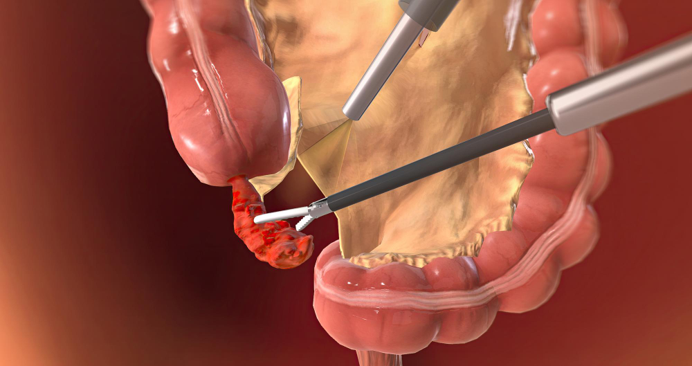 التهاب الزائدة الدودية وألم أسفل البطن الأيمن الذي قد يستدعي جراحة عاجلة