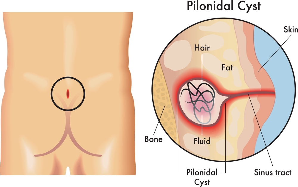 الناسور العصعصي والتهاب أسفل الظهر عند منطقة العصعص وطرق علاجه نهائيًا