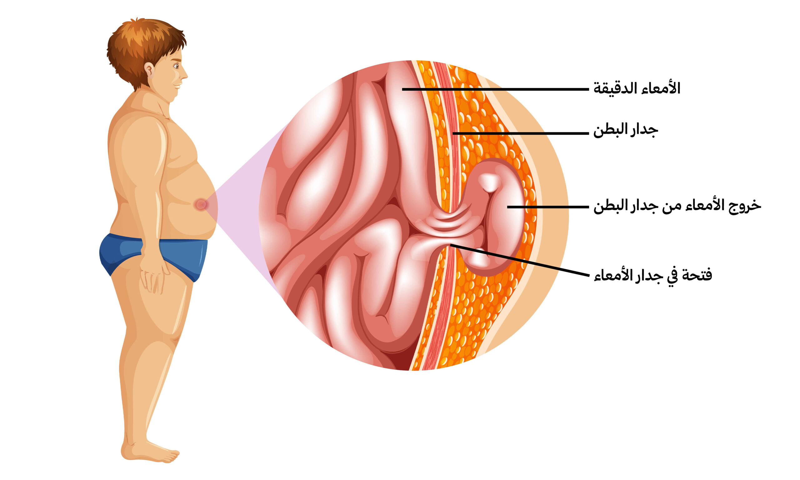 الفتق في جدار البطن وانتفاخ البطن الناتج عن ضعف عضلات البطن