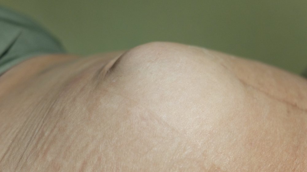 الفتق في جدار البطن وانتفاخ البطن الناتج عن ضعف عضلات البطن – توضيح لحالة الفتق التي قد تحتاج إلى تقييم جراحي